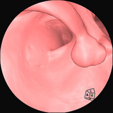 大腸CTの仮想内視鏡像