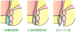 シートン法