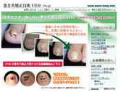 巻き爪矯正技術VHO