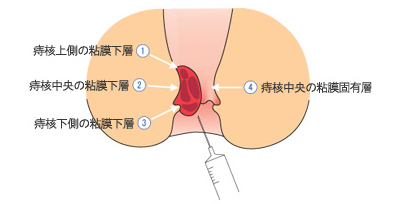 四段階注射法